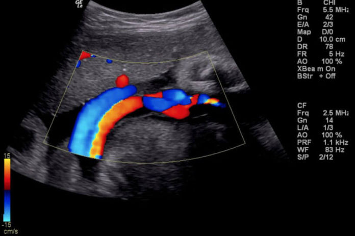 Doppler Obstétrico Color